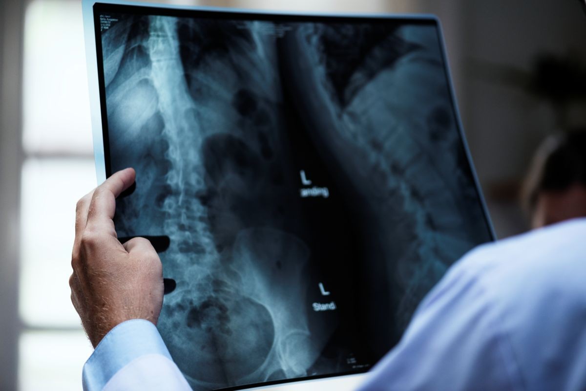Spine Tumor Surgery
